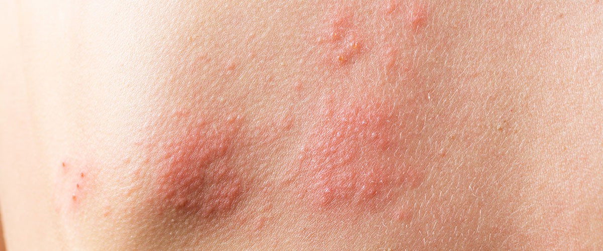 Acerca de las infecciones en la piel