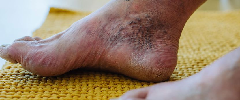 Experto Universitario en Manejo Avanzado de Úlceras y Patologías Vasculares y Hematológicas para Enfermería