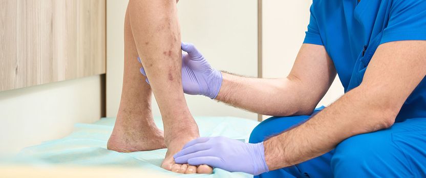 Curso Universitario de Especialización en Estrategias de Intervención en Fisioterapia Venosa y Linfática