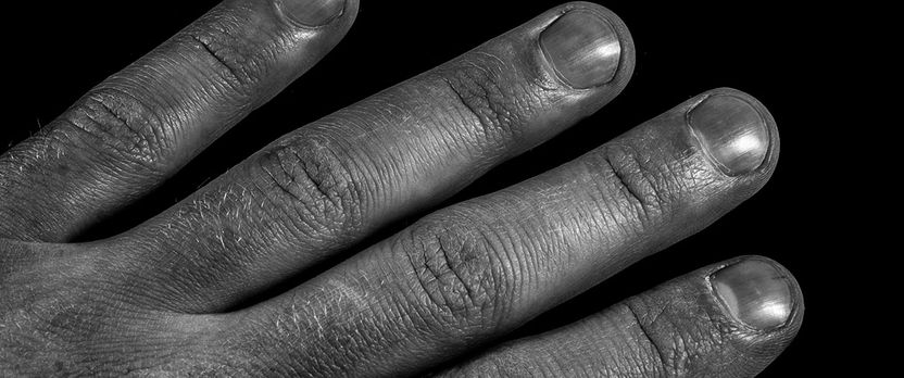 Curso de Desarrollo Profesional en Síndrome de Raynaud: Intervención Médica y Psicológica