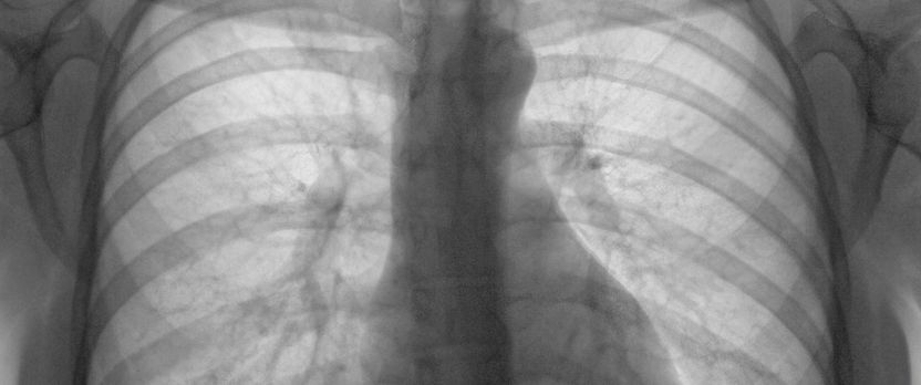 Curso de Desarrollo Profesional en Radiología Torácica y Patologías Pulmonares