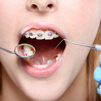 Curso Universitario de Especialización en Periodoncia para Higienistas Dentales