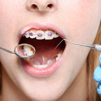 Imagen de Curso Universitario de Especialización en Periodoncia para Higienistas Dentales