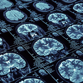 Imagen de Curso Universitario de Especialización en Neurocirugía Básica