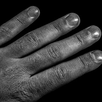 Imagen de Curso de Desarrollo Profesional en Síndrome de Raynaud: Intervención Médica y Psicológica