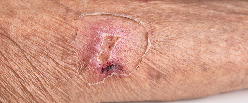 Prevención, valoración y tratamiento integral de las úlceras por presión y heridas crónicas